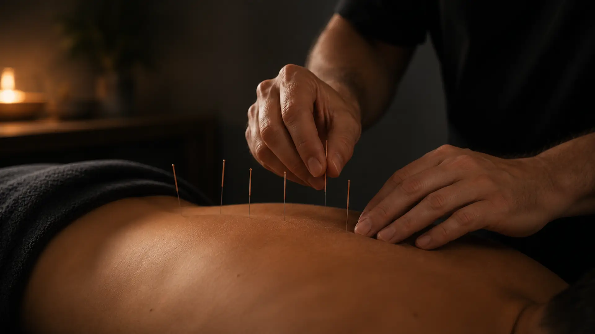 Professional acupuncture treatment at MG Rehab clinic in Richmond